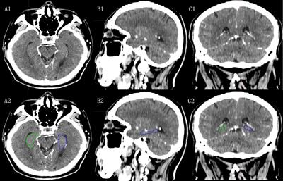 Hippocampal sparing in whole-brain radiotherapy for brain metastases: controversy, technology and the future